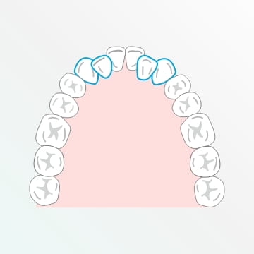 歯並びのアーチが狭い場合
