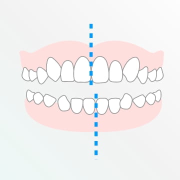 噛み合わせに問題がでるような歯並び