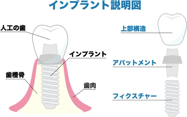 インプラントについて