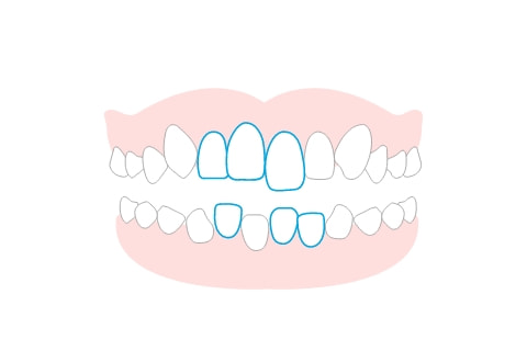 叢生（ガタガタの歯並び）
