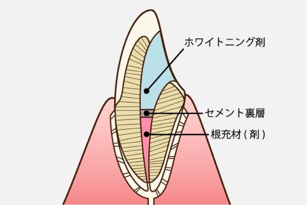 歯の内側からのアプローチ