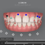 マウスピース矯正のシュミレーション