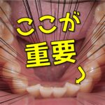 上の前歯だけ矯正したいという方へ